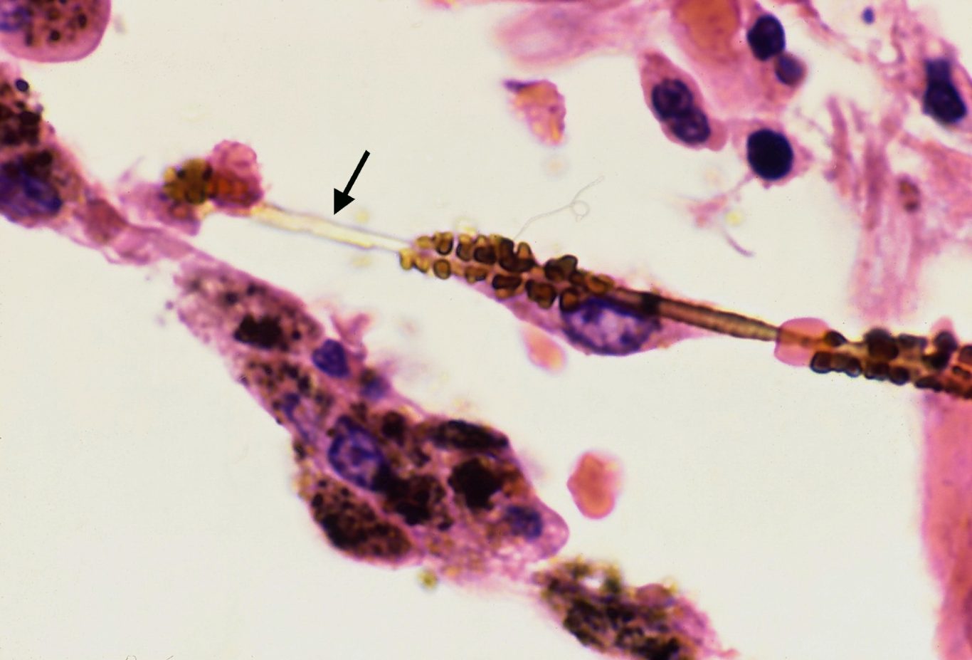 Asbestose (Yale Rosen) Asbestose (Yale Rosen)